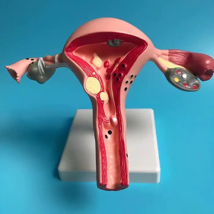 Nouveau modèle de ovaire d'utérus pathologique humain, Structure de Section transversale, modèle d'a
