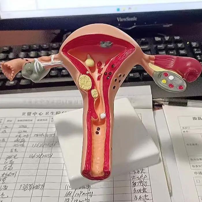 Nouveau modèle de ovaire d'utérus pathologique humain, Structure de Section transversale, modèle d'anatomie anatomique de l'utérus, outil d'enseignement des organes féminins