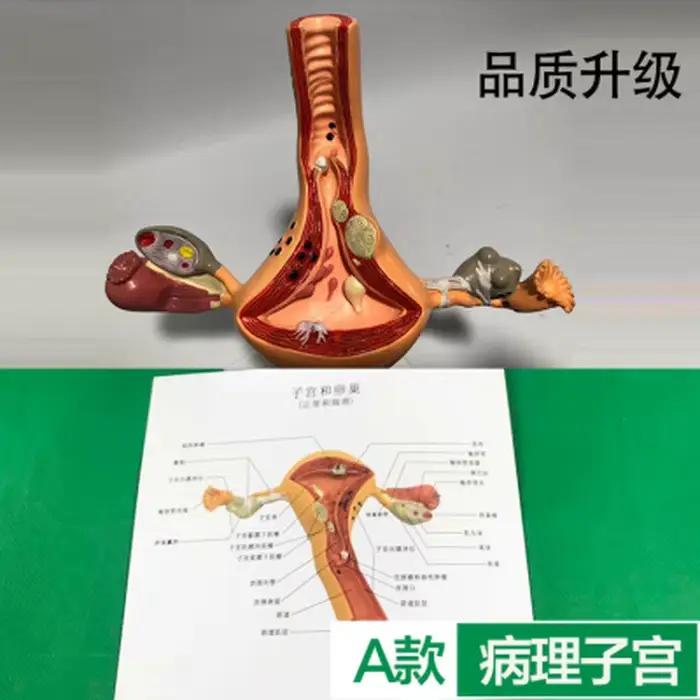 Modèle de dissection de la maladie de l'ovaire et de l'utérus féminin, atoologie, enseignement des aides médicales humaines, anatomie, lésion, utérus