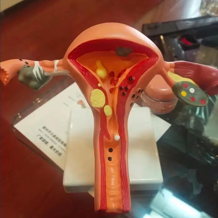 Nouveau modèle de ovaire d'utérus pathologique humain, Structure de Section transversale, modèle d'anatomie anatomique de l'utérus, outil d'enseignement des organes féminins