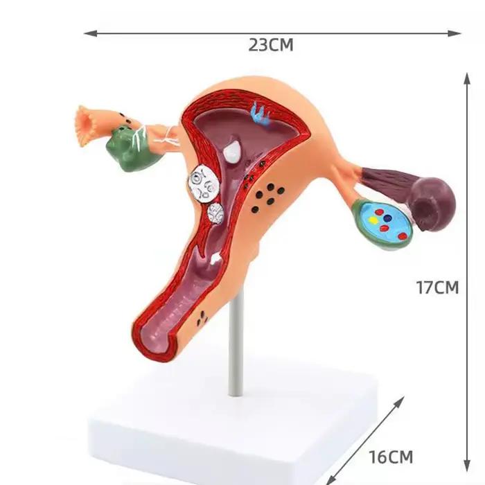 Nouveau modèle de ovaire d'utérus pathologique humain, Structure de Section transversale, modèle d'anatomie anatomique de l'utérus, outil d'enseignement des organes féminins